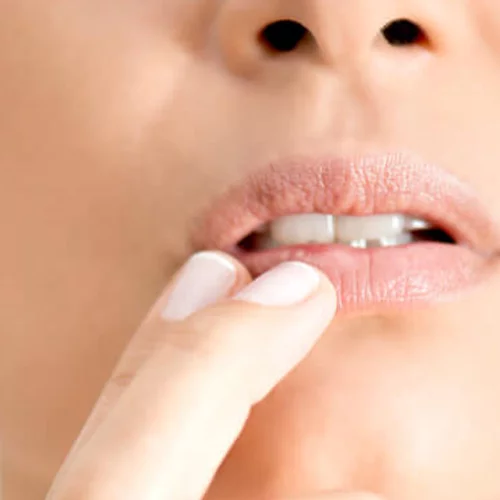 Επιχείλιος έρπης: Τα αίτια, η θεραπεία και η αντιμετώπιση του ιού