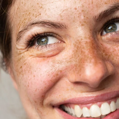 Smile lines: Το έξυπνο hack για να βελτιώσεις την όψη των ρυτίδων γύρω από το στόμα