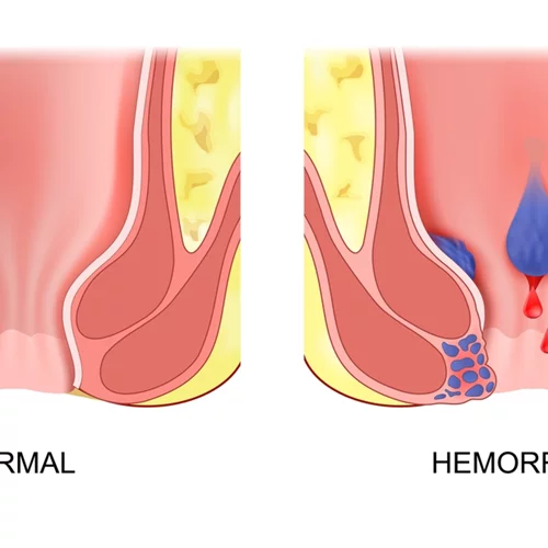 Αντιμετώπιση αιμορροΐδων με laser: Τι πρέπει να ξέρεις