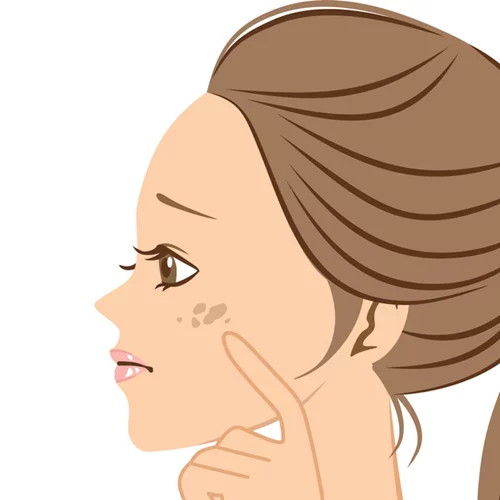 Υπερμελάγχρωση: Τα SOS της αντιμετώπισης των καφέ κηλίδων στο δέρμα