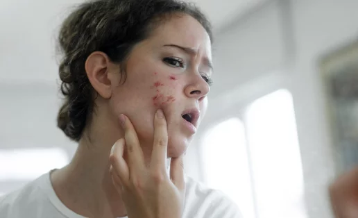 Οι 4 τρόποι που σβήνουν τις ουλές ακμής