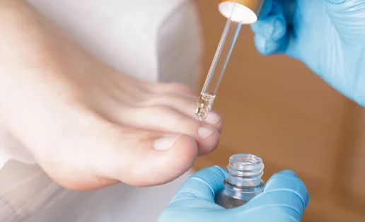 Είσφρυση όνυχος: Πώς το θεραπεύσεις αποτελεσματικά