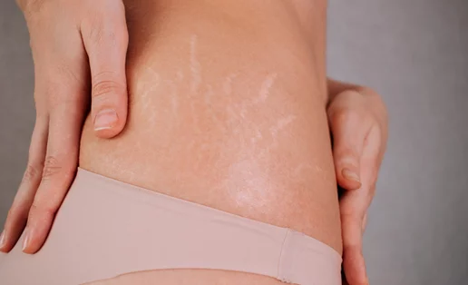 Τι είναι οι ραγάδες και η σωστή πρόληψη/αντιμετώπισή τους