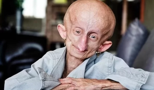 Πέθανε στα 19 της χρόνια η Beandri Booysen - Έπασχε από τη σπάνια ασθένεια της προγηρίας