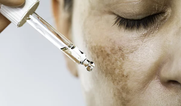 Σκούρες κηλίδες στο πρόσωπο: Οι 5 καλύτεροι οροί για την εξάλειψή τους