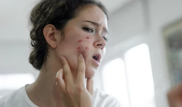 Οι 4 τρόποι που σβήνουν τις ουλές ακμής