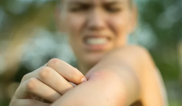Τσιμπήματα κουνουπιών: Τι είναι αυτό που έλκει τα κουνούπια πάνω μας;