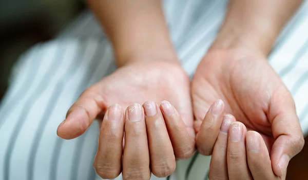 Αυτά τα σημάδια στα νύχια σου μπορεί να δείχνουν σοβαρό πρόβλημα - Μάθε ποια είναι!