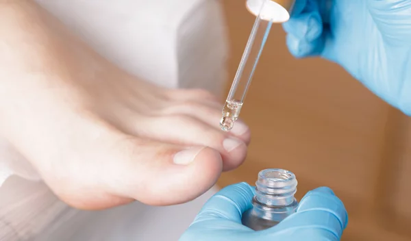 Είσφρυση όνυχος: Πώς το θεραπεύσεις αποτελεσματικά