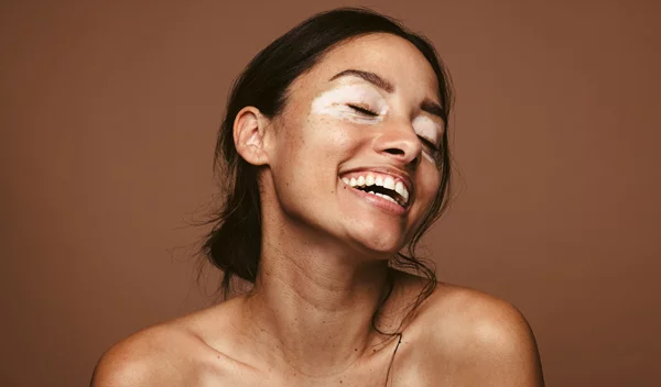 Τι είναι η λεύκη; Η θεραπεία και συμβουλές για το καλοκαίρι