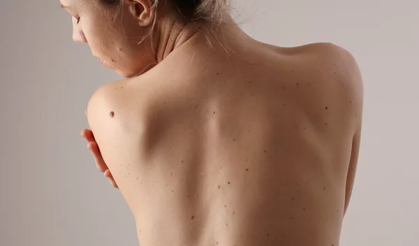 3 φυσικές τεχνικές για να καταπραΰνεις τον πόνο στην πλάτη