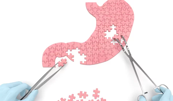 Τι είναι το γαστρικό μανίκι (Sleeve Gastrectomy); Τα πλεονεκτήματα και ποιους αφορά