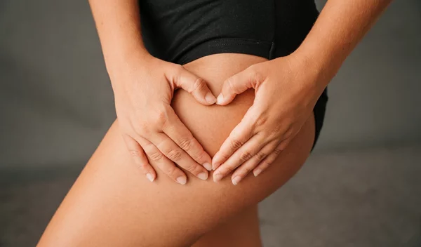 Πώς να μειώσεις την κυτταρίτιδα φυσικά, σύμφωνα με τους ειδικούς