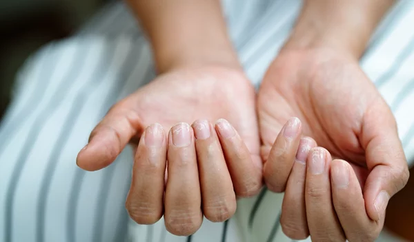 Αδύναμα νύχια μετά τις διακοπές; Ξέρουμε τι χρειάζεσαι ακριβώς