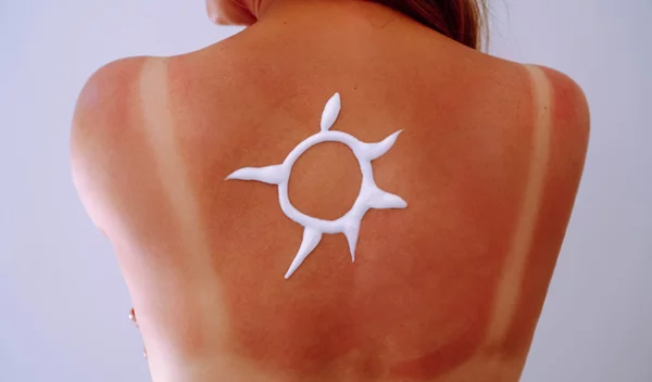 Πώς να θεραπεύσεις γρήγορα το ηλιακό έγκαυμα | Οδηγίες από δερματολόγο