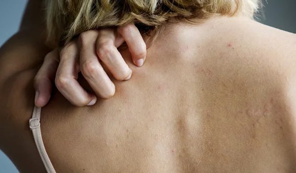 Γιατί τα κουνούπια "επιλέγουν" συγκεκριμένα άτομα; Η επιστήμη πίσω από τα τσιμπήματα