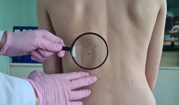 Ελιές στο δέρμα: Τι είναι η χαρτογράφηση σπίλων;