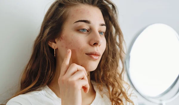 Άμεση δράση: 7 προϊόντα που "εξαφανίζουν" τα σπυράκια, τα στίγματα και τα σημάδια