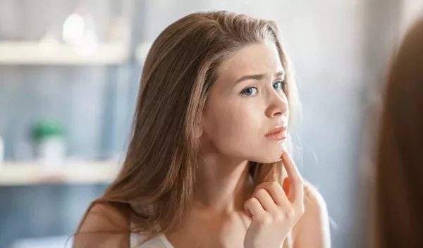 Ακμή στο πηγούνι: Σε τι οφείλεται και πώς μπορείς να την αντιμετωπίσεις