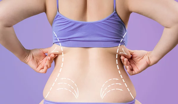 Λιποκύτταρα: Οι επιστήμονες βρήκαν πώς θα τα συρικνώσουν!