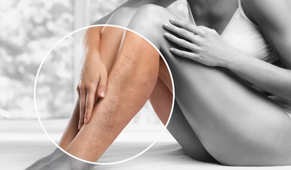 Έχω σακχαρώδη διαβήτη και έβγαλα και κιρσούς, τι να κάνω;