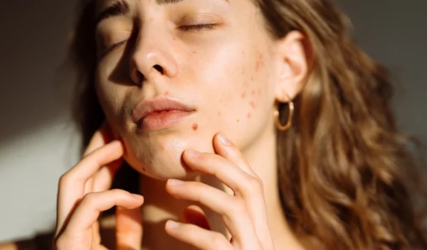 Προβιοτικά: Μπορούν να σε βοηθήσουν να "ξεφορτωθείς" την ακμή;