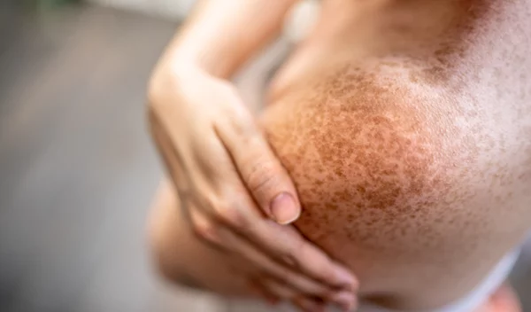 Μπορούν οι φυτικές ίνες στη διατροφή σου να σε προστατεύσουν από δερματικές παθήσεις;