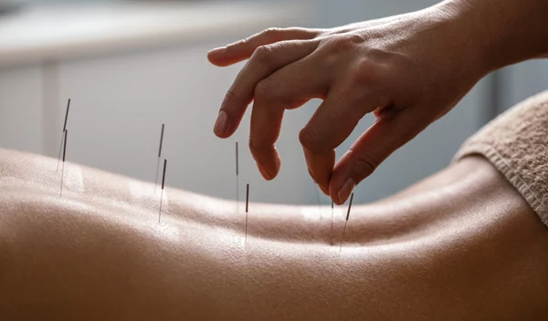 Μάθε τα οφέλη της χρήσης του βελονισμού στο 11ο Διεπιστημονικό Συμπόσιο Βελονισμού