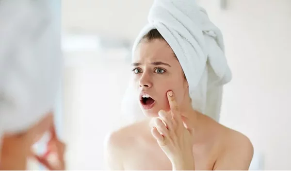 Ακμή; 5 tips για να ξεκινήσεις να την αντιμετωπίζεις από σήμερα κιόλας