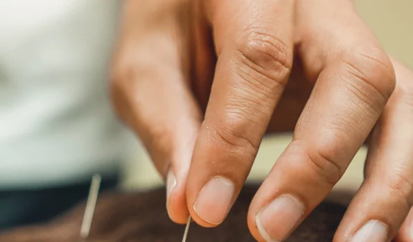 Πώς μπορεί ο βελονισμός να βοηθήσει την αισθητική και το αδυνάτισμα;