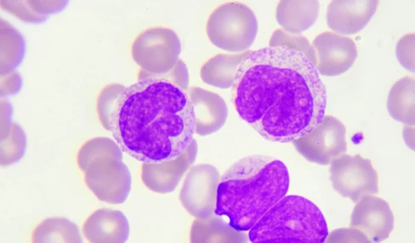 Τι πρέπει να γνωρίζεις για την Χρόνια Λεμφοκυτταρική Λευχαιμία (ΧΛΛ)