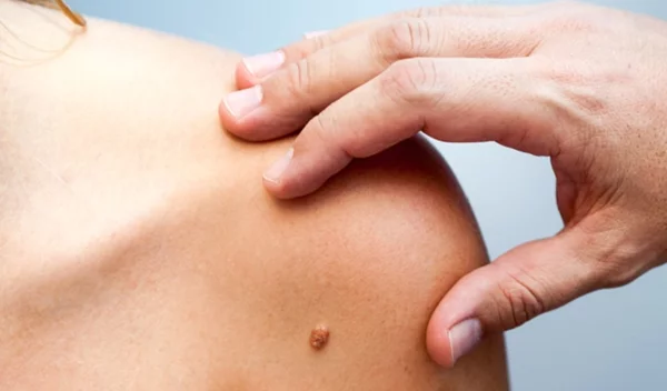 Καρκίνος των πνευμόνων, του δέρματος και άλλα είδη: Οι 3 κινήσεις για πρόληψη