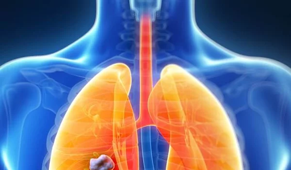 Πώς η ανοσοθεραπεία βοηθάει στην αντιμετώπιση του προχωρημένου καρκίνου του πνεύμονα