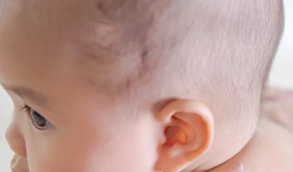 Ατοπική δερματίτιδα: Τι είναι το αλλεργικό έκζεμα