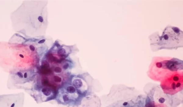 «Nα ανησυχώ για μόλυνση από τον ιό των κονδυλωμάτων (HPV);»