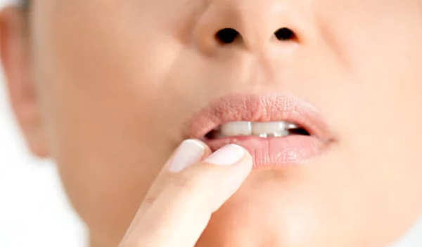 Επιχείλιος Έρπης: Οι εναλλακτικές θεραπείες που αξίζει να ξέρεις