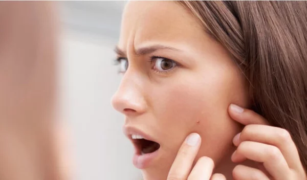 Μπορείς να σπάσεις σωστά ένα σπυράκι στο πρόσωπο;