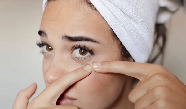 Ποια είναι η θεραπεία για την ακμή; Η δερματολόγος απαντά