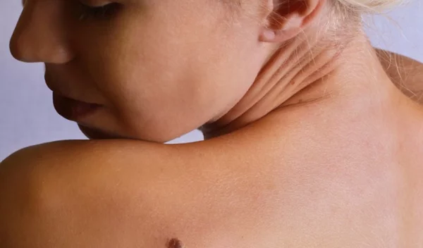 Μελάνωμα: Τι να προσέχεις και πώς αντιμετωπίζεται