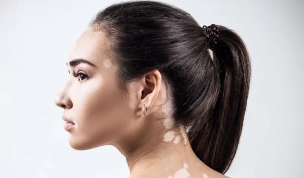 Η λεύκη στο δέρμα θεραπεύεται! Μάθε τα νέα δεδομένα