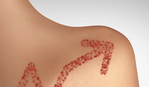 Ιλαρά 2019 Update: Μάθε πώς επηρεάζει το ανοσοποιητικό σου σύστημα