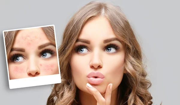 Τι είναι η ροδόχρους ακμή; 6 facts για τη νόσο από την οποία πάσχει η Σοφία Φαραζή