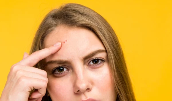 Θηλώματα του δέρματος και πώς αντιμετωπίζονται