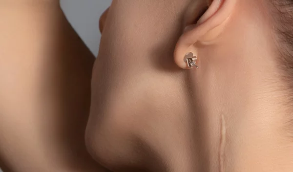 Η βιταμίνη Ε μειώνει τις ουλές;