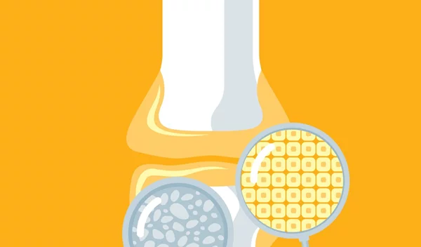 Ψωριασική αρθρίτιδα: Ποιες ηλικίες αφορά, τα συμπτώματα και η έγκριση μιας νέας θεραπείας που θα αλλάξει τα δεδομένα