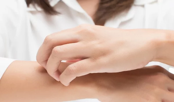 Έκζεμα στα χέρια: Ξεκινά η πρώτη κλινική μελέτη φάσης 3 για τη νόσο