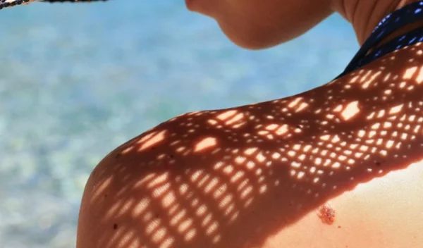 Καρκίνος του δέρματος: 4 βασικά πράγματα που πρέπει να γνωρίζεις