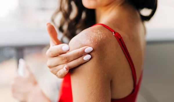 Κάηκες από τον ήλιο και ξεφλούδισες; Τι ΔΕΝ πρέπει να κάνεις;