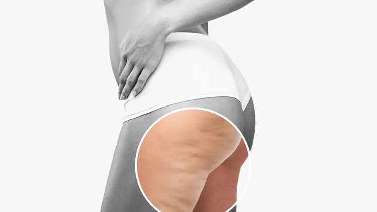cellulite