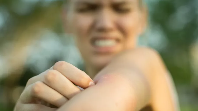 Γυναίκα που ξύνει τσίμπημα κουνουπιού